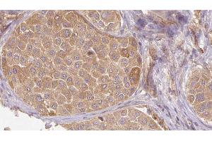 ABIN6272659 at 1/100 staining Human Melanoma tissue by IHC-P. (MFGE8 抗体  (C-Term))