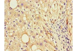 Immunohistochemistry of paraffin-embedded human liver cancer using ABIN7156880 at dilution of 1:100 (EBI3 抗体  (AA 21-227))