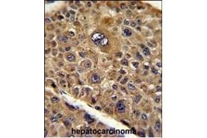 Formalin-fixed and paraffin-embedded human hepatocarcinoma reacted with TOB1 Antibody (N-term), which was peroxidase-conjugated to the secondary antibody, followed by DAB staining. (Protein Tob1 (TOB1) (AA 54-83), (N-Term) 抗体)