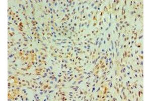Immunohistochemistry of paraffin-embedded human breast cancer using ABIN7149005 at dilution of 1:100 (CST4 抗体  (AA 21-141))
