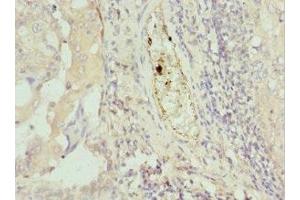 Immunohistochemistry of paraffin-embedded human lung cancer using ABIN7172749 at dilution of 1:100 (Protein C8orf4 (TCIM) (AA 1-106) 抗体)
