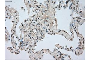 Immunohistochemical staining of paraffin-embedded Adenocarcinoma of breast tissue using anti-NTRK3 mouse monoclonal antibody. (NTRK3 抗体)