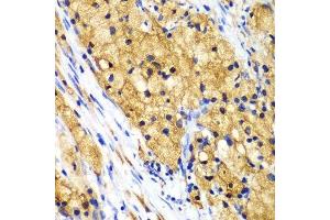 Immunohistochemistry of paraffin-embedded human lung cancer using CAPG Antibody. (CAPG 抗体  (AA 1-348))