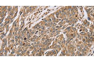 Immunohistochemistry of paraffin-embedded Human lung cancer using PTGER2 Polyclonal Antibody at dilution of 1:45 (PTGER2 抗体)