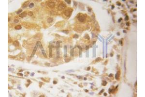ABIN6269055 at 1/50 dilution staining IKB epsilon in human breast carcinoma by Immunohistochemistry using paraffin-embedded tissue (Survivin 抗体  (Internal Region))