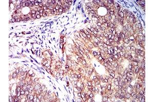 Immunohistochemical analysis of paraffin-embedded cervical cancer tissues using CD158E1 mouse mAb with DAB staining. (KIR3DL1 抗体  (AA 206-340))