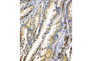 Anti-HEXA antibody, IHC(P) IHC(P):Human Intestinal Cancer Tissue (Hexosaminidase A 抗体  (Middle Region))