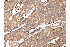 The image on the left is immunohistochemistry of paraffin-embedded Human prostate cancer tissue using ABIN7128064(UGGT2 Antibody) at dilution 1/20, on the right is treated with fusion protein. (UGCGL2 抗体)