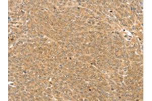 The image on the left is immunohistochemistry of paraffin-embedded Human ovarian cancer tissue using ABIN7192889(TRIM22 Antibody) at dilution 1/25, on the right is treated with synthetic peptide. (TRIM22 抗体)
