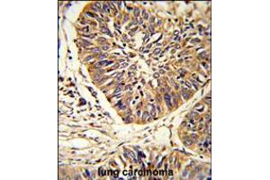 Formalin-fixed and paraffin-embedded human lung carcinoma reacted with PDIA3 Antibody , which was peroxidase-conjugated to the secondary antibody, followed by DAB staining. (PDIA3 抗体  (C-Term))