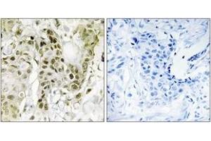 Immunohistochemistry analysis of paraffin-embedded human breast carcinoma tissue, using BCOR Antibody. (BCOR 抗体  (AA 1231-1280))