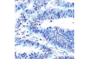 Immunohistochemistry of paraffin-embedded human colon carcinoma using PTBP1 Rabbit mAb (ABIN7269464) at dilution of 1:100 (40x lens). (PTBP1 抗体)