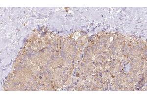 ABIN6273327 at 1/100 staining Human thyroid cancer tissue by IHC-P. (Syntaxin 17 抗体  (C-Term))