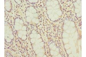 Immunohistochemistry of paraffin-embedded human colon cancer using ABIN7145307 at dilution of 1:100 (BCL2-Like 15 抗体  (AA 1-163))