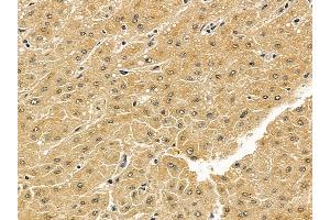 HLA-G Mouse Monoclonal Antibody at 1/100 staining human liver cancer by IHC-P.