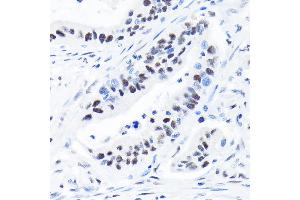 Immunohistochemistry of paraffin-embedded human colon carcinoma using SUPT5H/SPT5 Rabbit mAb (ABIN7270878) at dilution of 1:100 (40x lens). (SUPT5H 抗体)