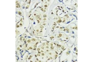 Immunohistochemistry of paraffin-embedded human mammary cancer using BA antibody (ABIN7265937) at dilution of 1:200 (40x lens). (BAZ2A 抗体)