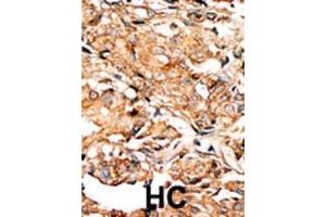 Formalin-fixed and paraffin-embedded human cancer tissue reacted with the primary antibody, which was peroxidase-conjugated to the secondary antibody, followed by AEC staining. (RAD9A 抗体  (pSer277))