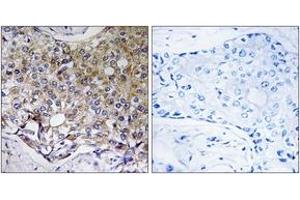 Immunohistochemistry analysis of paraffin-embedded human breast carcinoma tissue, using ATG4A Antibody. (ATG4A 抗体  (AA 81-130))