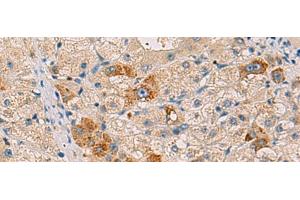 Immunohistochemistry of paraffin-embedded Human liver cancer tissue using RMDN2 Polyclonal Antibody at dilution of 1:50(x200) (FAM82A1 抗体)