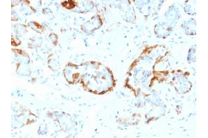 Formalin-fixed, paraffin-embedded human Breast stained with Crystallin Alpha B Mouse Monoclonal Antibody (CPTC-CYRAB-1). (CRYAB 抗体)