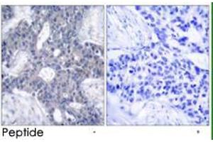Immunohistochemical analysis of paraffin-embedded human breast carcinoma tissue using ZAP70 polyclonal antibody  . (ZAP70 抗体)