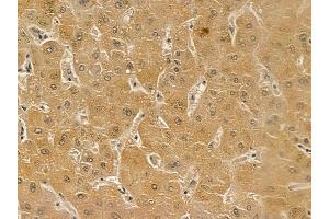 Estrogen-induced gene 121 protein Mouse Monoclonal Antibody at 1/100 staining human liver cancer by IHC-P. (ELAPOR1 抗体)
