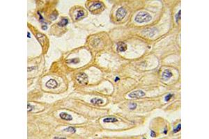 IHC testing of FFPE human lung carcinoma with ROR1 antibody. (ROR1 抗体)
