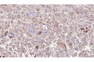 ABIN6268692 at 1/100 staining Human Melanoma tissue by IHC-P. (IL-8 抗体  (Internal Region))