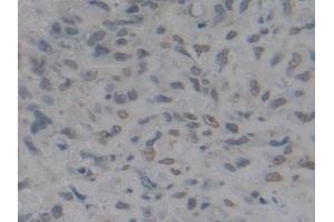 Detection of HMGB1 in Human Lung cancer Tissue using Polyclonal Antibody to High Mobility Group Protein 1 (HMGB1) (HMGB1 抗体  (AA 9-163))
