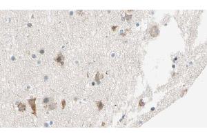 ABIN6274542 at 1/100 staining Human brain cancer tissue by IHC-P. (SHPK 抗体  (N-Term))