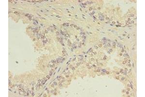 Immunohistochemistry of paraffin-embedded human prostate cancer using ABIN7147411 at dilution of 1:100 (CEP63 抗体  (AA 1-495))