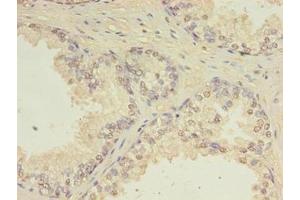 Immunohistochemistry of paraffin-embedded human prostate cancer using ABIN7147411 at dilution of 1:100 (CEP63 抗体  (AA 1-495))