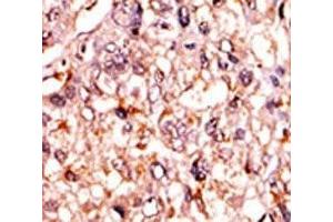 Immunohistochemistry (IHC) image for anti-Tumor Protein P53 (TP53) (pSer315) antibody (ABIN3029388)