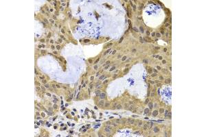 Immunohistochemistry of paraffin-embedded human oophoroma using TERF2IP antibody (ABIN5975683) at dilution of 1/100 (40x lens). (RAP1 抗体)