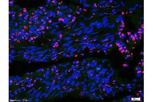 Formalin-fixed and paraffin-embedded human colon carcinoma labeled with Anti-DATF1/IDO1 Polyclonal Antibody, Unconjugatedused at 1:200 dilution for 40 minutes at 37°C. (IDO1 抗体  (AA 1-100))