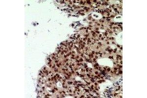 Immunohistochemical analysis of CNOT7 staining in human ovarian cancer formalin fixed paraffin embedded tissue section.