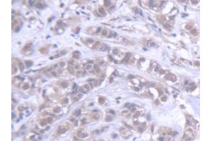 DAB staining on IHC-P; Samples: Human Breast cancer Tissue (ABCB6 抗体  (AA 590-842))
