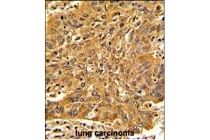 Formalin-fixed and paraffin-embedded human lung carcinoma with Fascin Antibody (Center), which was peroxidase-conjugated to the secondary antibody, followed by DAB staining. (Fascin 抗体  (AA 322-350))