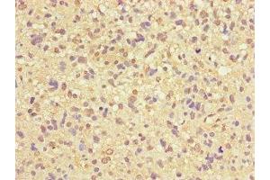 Immunohistochemistry of paraffin-embedded human glioma using ABIN7166372 at dilution of 1:100 (ZNF365 抗体  (AA 241-401))