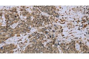 Immunohistochemistry of paraffin-embedded Human cervical cancer tissue using DCTN4 Polyclonal Antibody at dilution 1:50 (Dynactin 4 抗体)