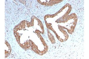 Formalin-fixed, paraffin-embedded human Prostate Carcinoma stained with COX-2 Recombinant Rabbit Monoclonal Antibody (COX2/3232R).