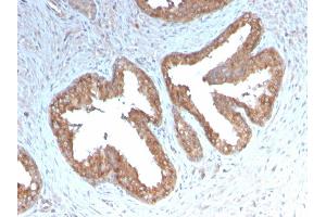 Formalin-fixed, paraffin-embedded human Prostate Carcinoma stained with COX-2 Recombinant Rabbit Monoclonal Antibody (COX2/3232R). (Recombinant PTGS2 抗体  (AA 442-572))