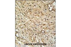 R Antibody (C-term) (ABIN651453 and ABIN2840247) immunohistochemistry analysis in formalin fixed and paraffin embedded human cervix carcinoma followed by peroxidase conjugation of the secondary antibody and DAB staining. (TWIST Neighbor 抗体  (C-Term))