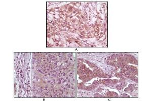 Immunohistochemical analysis of paraffin-embedded human pancreas carcinoma (A), esophagus carcinoma tissue (B) and ovary tumor tissue, showing cytoplasmic and membrane localization using 4E-BP1 antibody with DAB staining. (eIF4EBP1 抗体)
