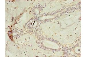 Immunohistochemistry of paraffin-embedded human breast cancer using ABIN7158845 at dilution of 1:100 (m-AAA Protease-Interacting Protein 1, Mitochondrial (MAIP1) (AA 97-291) 抗体)