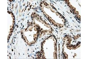 Immunohistochemical staining of paraffin-embedded Carcinoma of liver tissue using anti-LIPG mouse monoclonal antibody. (LIPG 抗体)