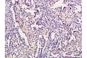 Formalin-fixed and paraffin embedded human breast cancer labeled with Anti-PHYH Polyclonal Antibody, Unconjugated  followed by conjugation to the secondary antibody and DAB staining (PHYH 抗体  (AA 1-100))