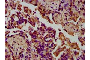 IHC image of ABIN7158078 diluted at 1:200 and staining in paraffin-embedded human lung cancer performed on a Leica BondTM system. (LGI4 抗体  (AA 292-412))