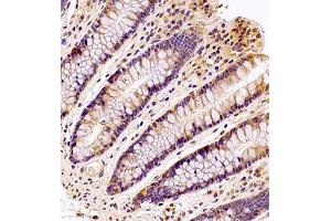 Immunohistochemistry analysis of paraffin embedded human colon using MTHFD1 (ABIN7074609) at dilution of 1: 700 (MTHFD1 抗体)